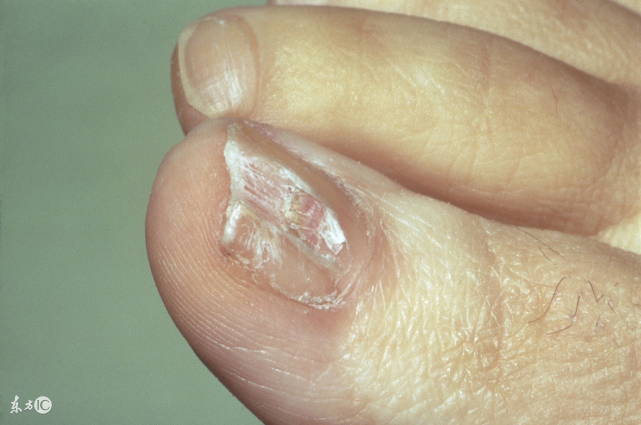 灰指甲的症状图片灰指甲有哪些症状