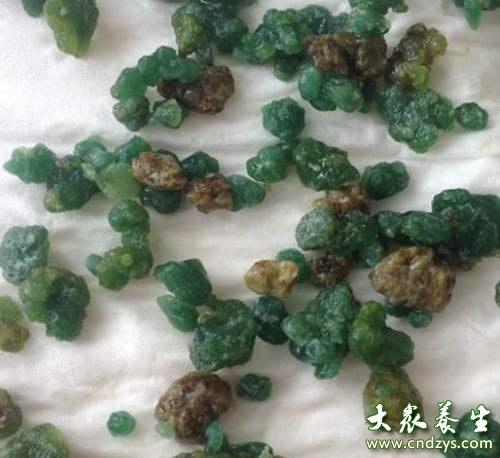 在家这么做竟然可以排出结石