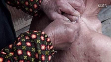 民间传承挑羊毛疔技术培训