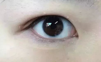 不做手术怎么从内双变成自然外双眼皮，只要坚持每天这样做