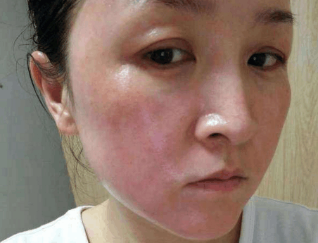 激素类药膏能常用吗？长期使用会造成哪些伤害？