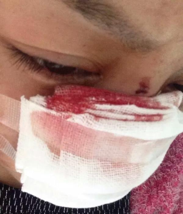30岁女子发帖筹集手术费用，称被丈夫酒后用刮眉刀割去鼻子