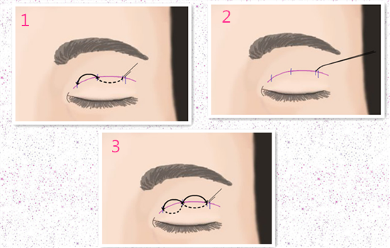 纳米无痕双眼皮的原理和步骤 采用可吸收双眼皮线