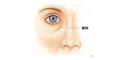 什么是泪沟，什么方法可以改善或者消除泪沟