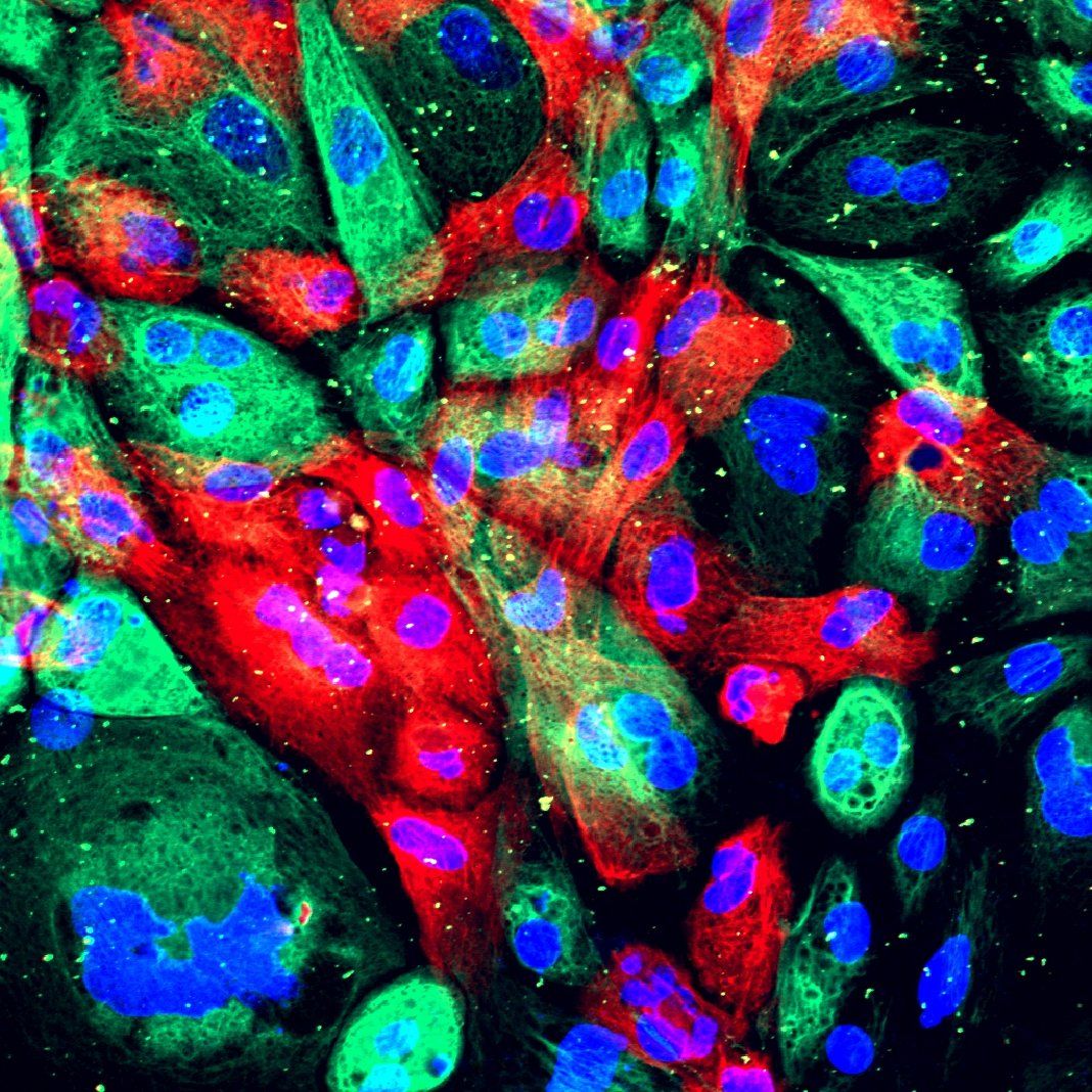 癌症基因“免疫景观”决定了前列腺肿瘤的发展