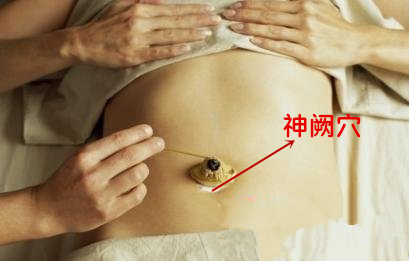 艾灸神阙穴治疗百病
