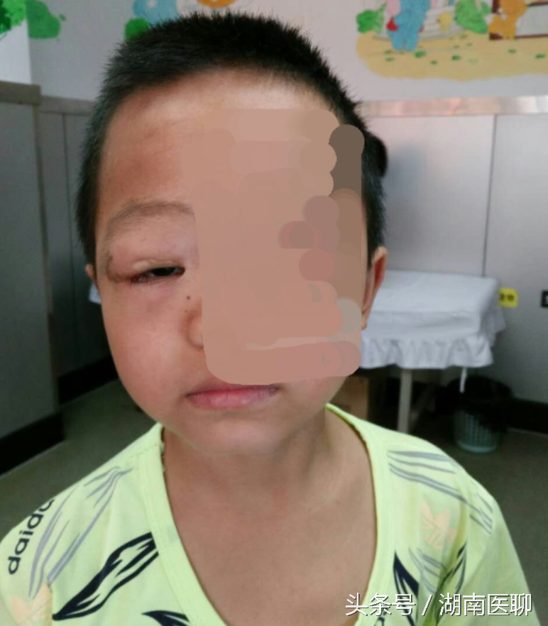 十岁男童胸背长咖啡色斑致右眼变形？罕见遗传病是祸首！