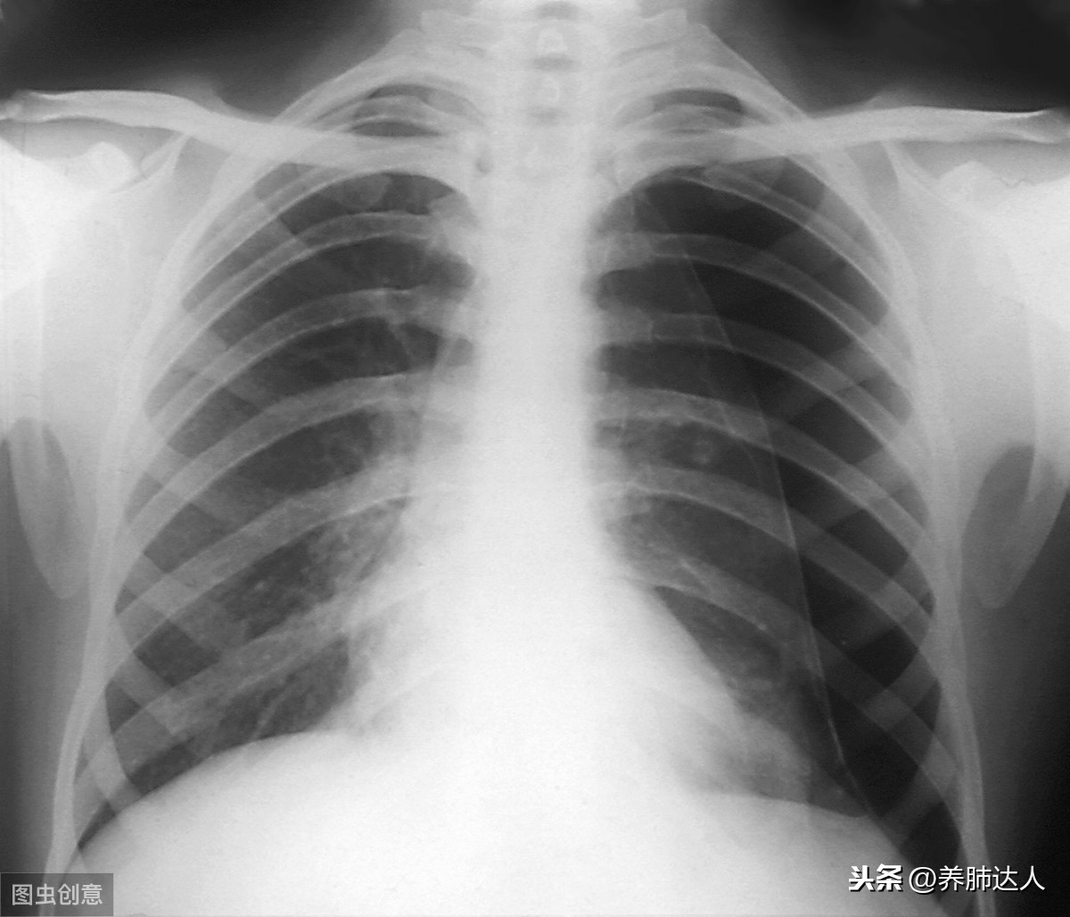 慢阻肺发展到晚期要多久？医生给出这个数字