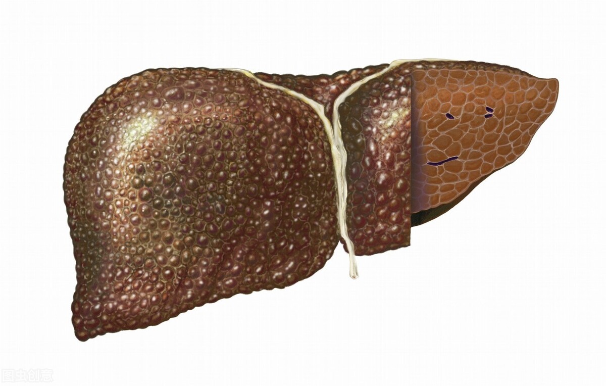你是否存在这些症状？要当心肝脏正在硬化，已经产生腹水