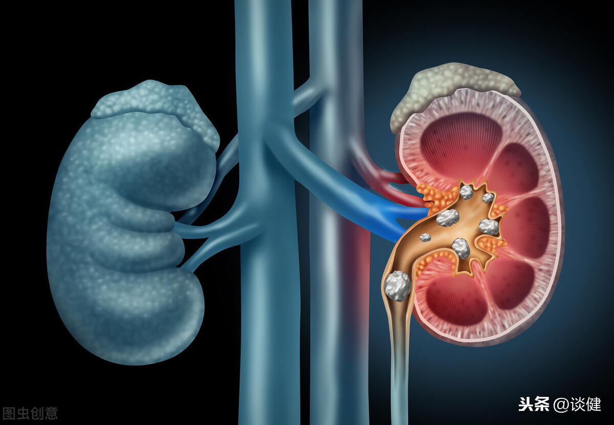 豆腐钙质高，多吃会得肾结石？辟谣：了解结石形成，啥都明白