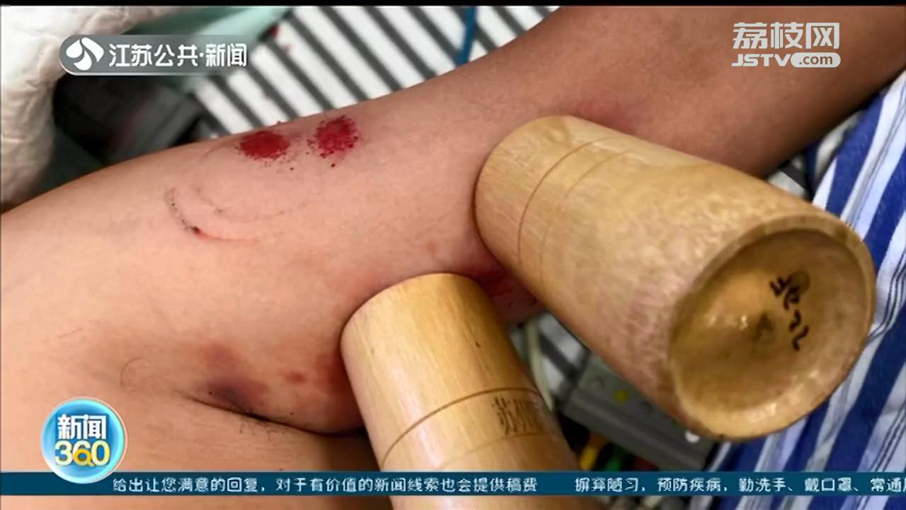 90后宝妈摘栗子碰到马蜂窝 全身被蜇了70多口，不幸身亡