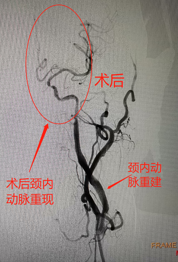 家里老人反复出现言语不利、一侧肢体无力，怎么办？