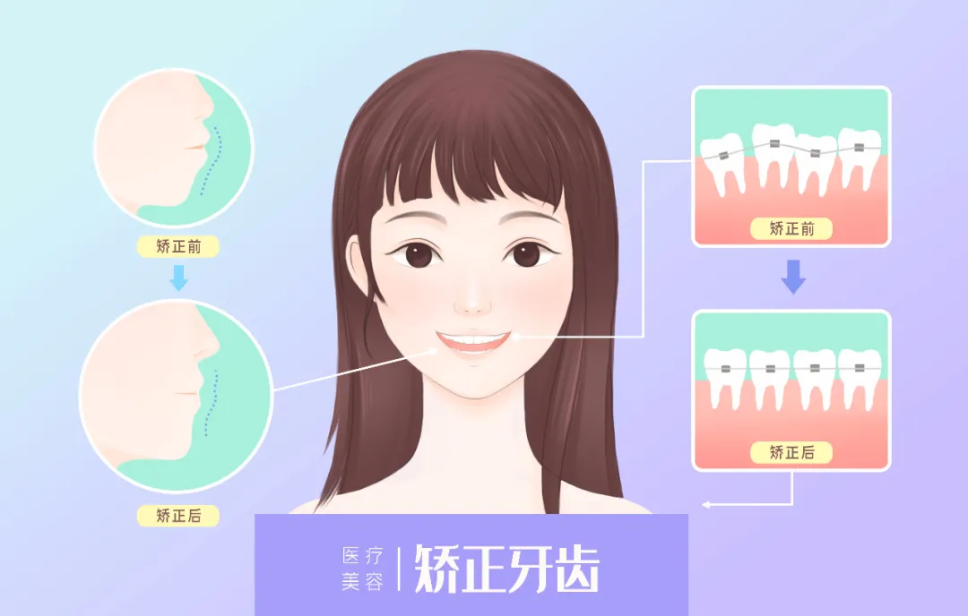 矫正后牙齿会松动？专业正畸医生带您走出牙齿矫正8个误区