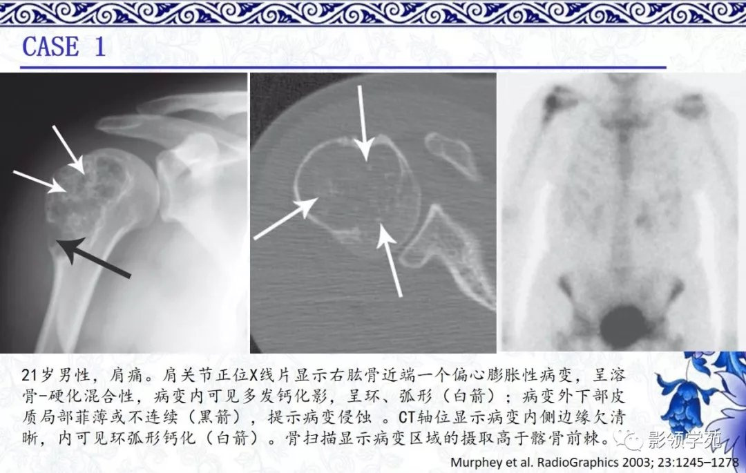 7种常见的软骨源性肿瘤的影像表现