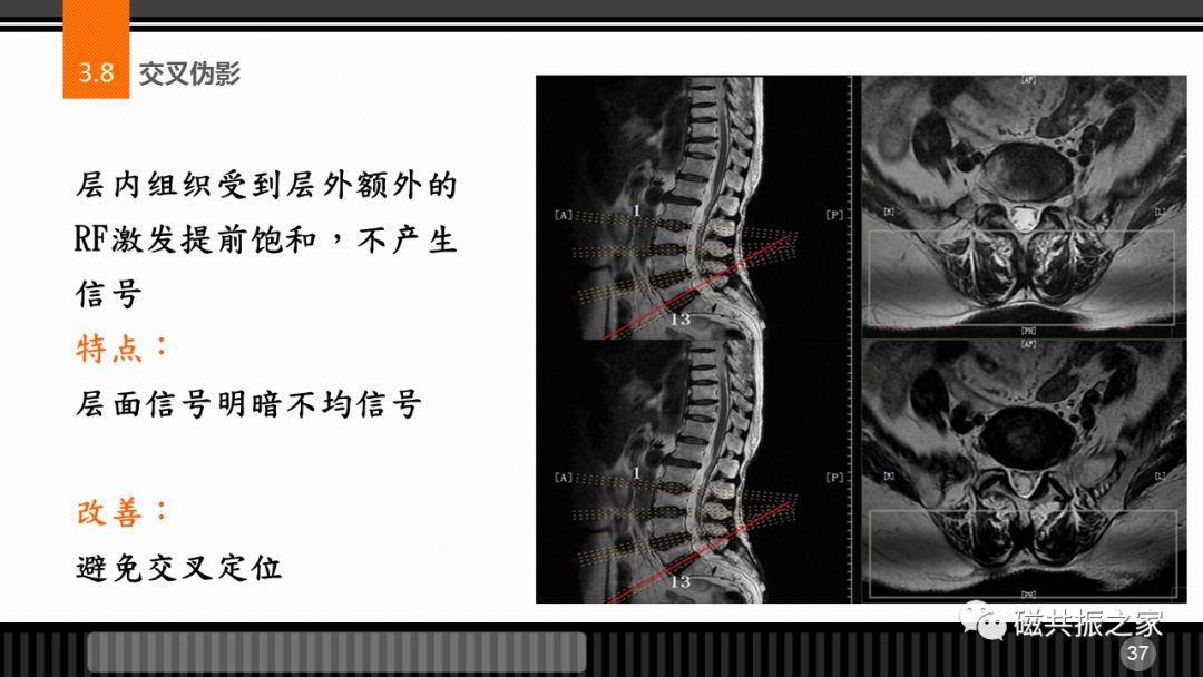 磁共振常见伪影及策略