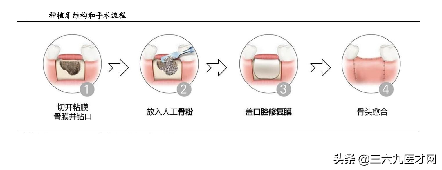 口腔修复材料：被低估的小而美赛道