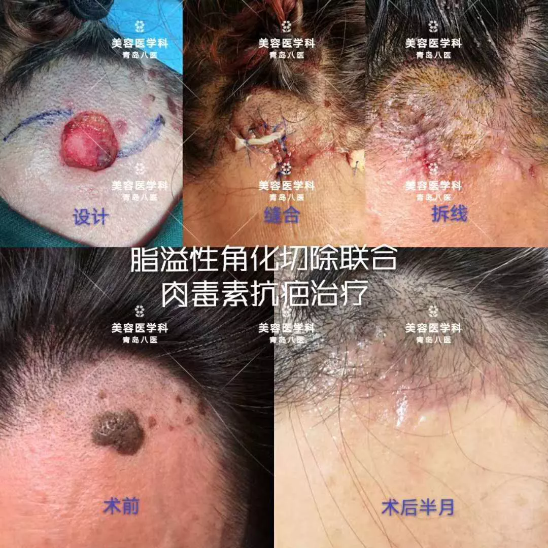 技术｜小切口，大学问——青岛市第八人民医院美容医学科