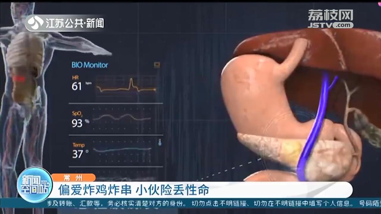 常州年轻小伙偏爱炸鸡炸串 引发严重胰腺炎险丢性命