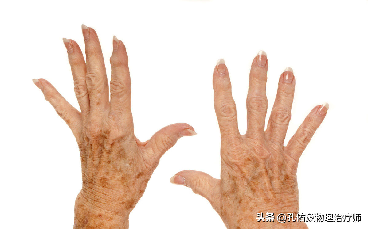 随着年龄的增长 老年斑越来越多 为什么呢?如何稀释去除?