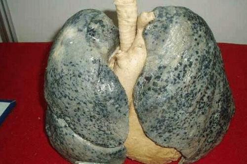 肺部是否健康，看看你是否有這幾個習慣，或許就能得出答案了