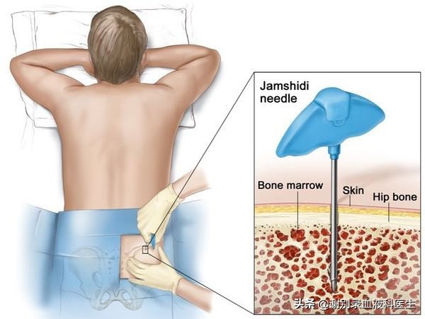 做骨穿有后遗症吗？