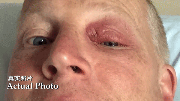 慎点当寄生虫钻进人体内的隐秘角落