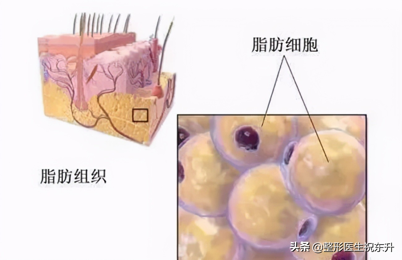 做了“自体脂肪填充面部”后，千万不能变胖？