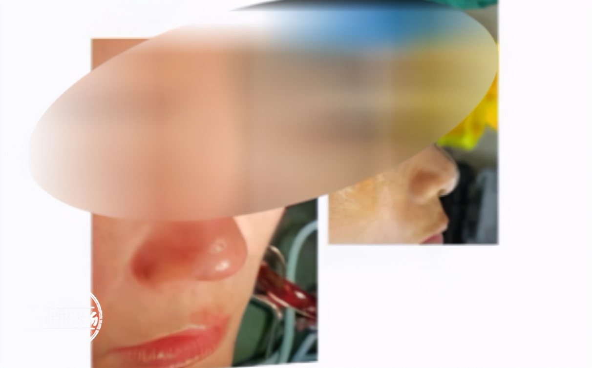 女子在南昌某三甲医院隆鼻后，红肿不透气！医生：这很难说