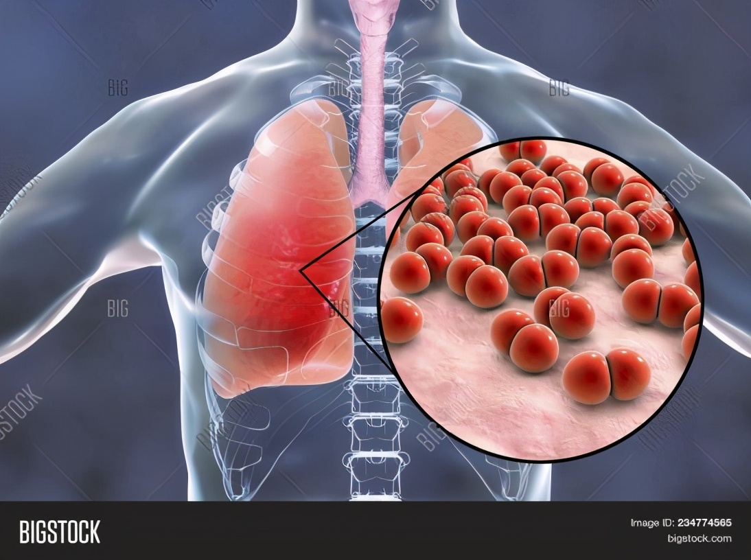 15价肺炎疫苗在美和欧盟提交上市申请：用于≥18岁成年人群