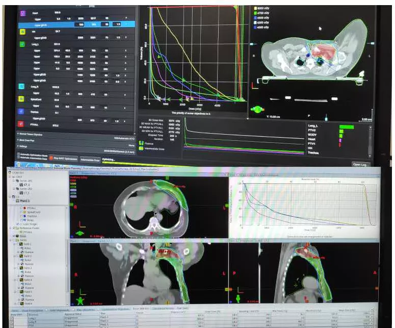 放疗物理师的日常