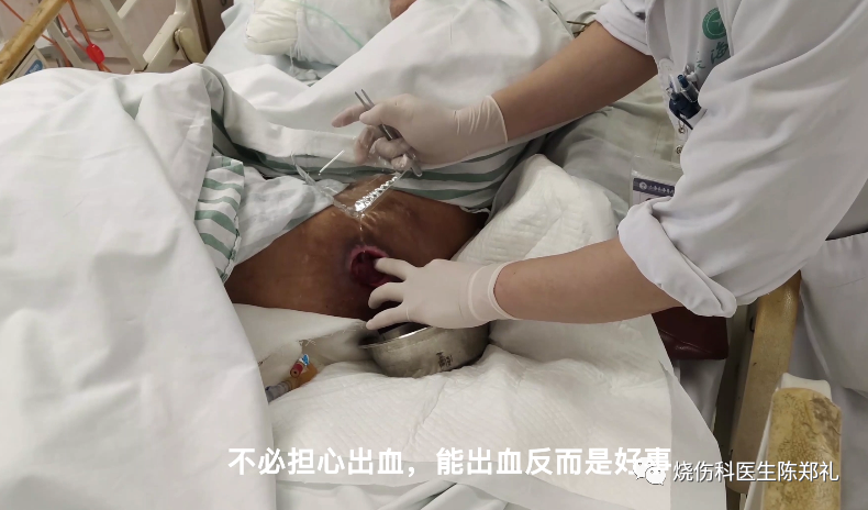 褥疮系列3：褥疮、窦道换药过程视频+图解