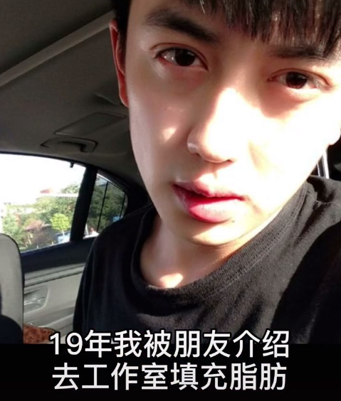 男網紅整容失敗，直播痛哭脂肪填充之後老了20歲，前後對比沒法看