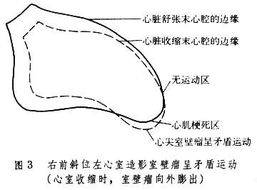 心肌梗死后，为什么有些人的心脏会长出“室壁瘤”？