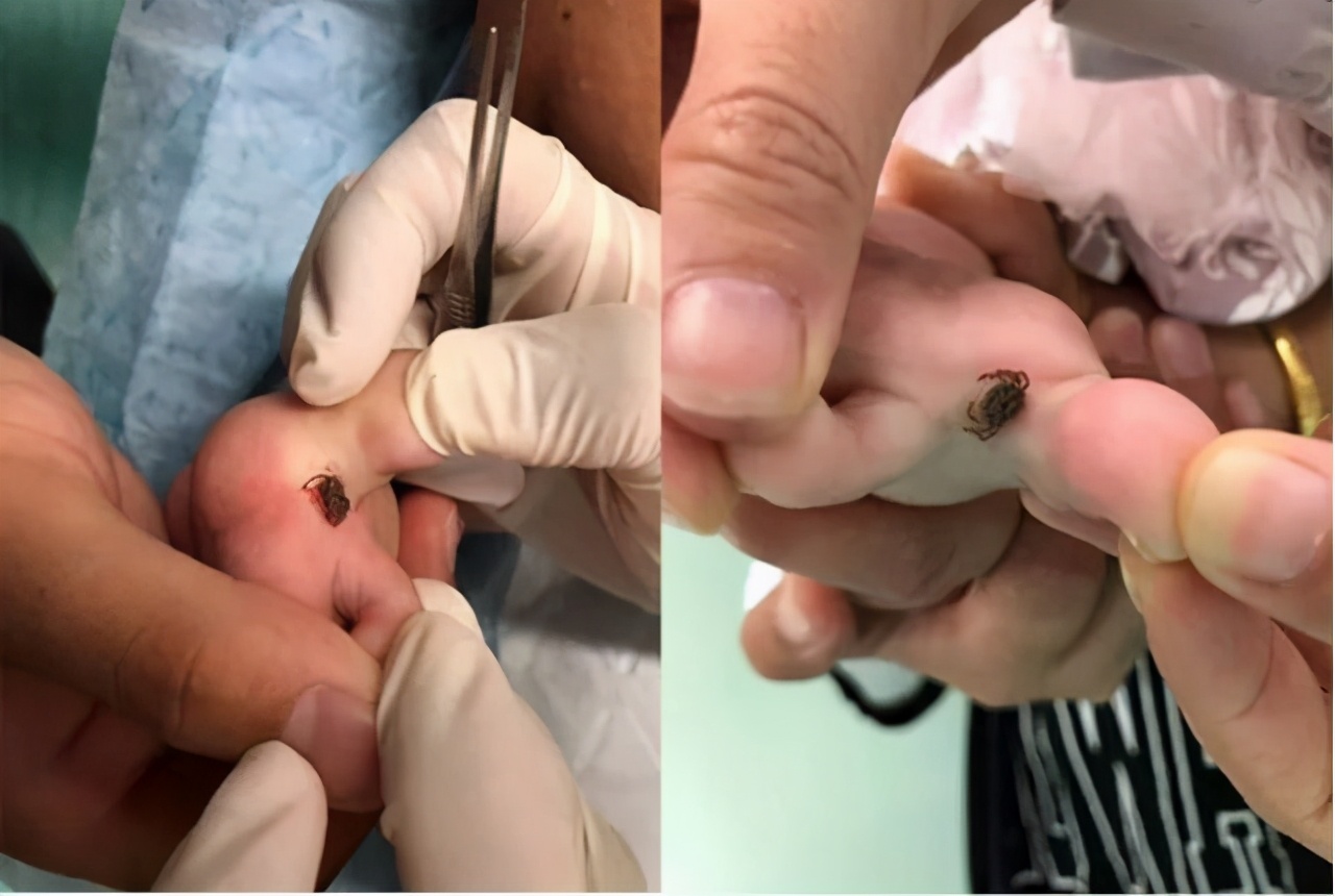 夏天户外千万小心这种夺命虫被叮咬后如何处理多数人不知道