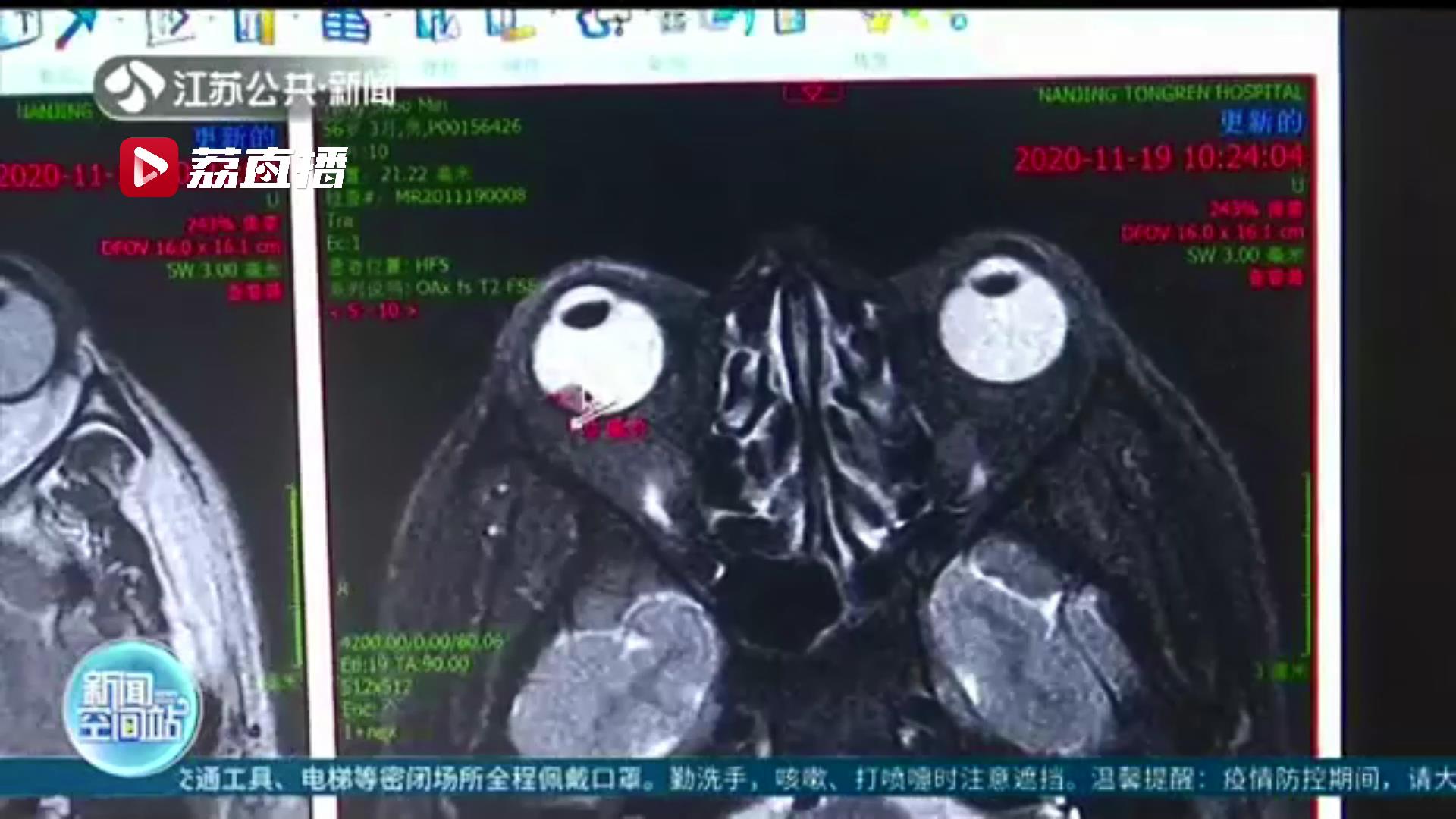 当心眼底疾病！南京一位56岁男子突患近视 病因是恶性肿瘤