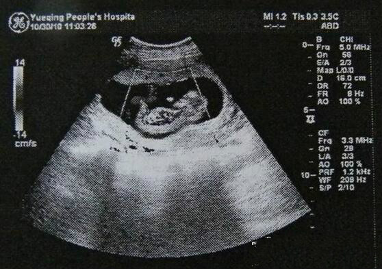 怀孕一个月b超图 让你一眼看懂b超图