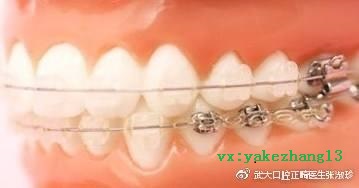 牙齿矫正的需要多长时间？