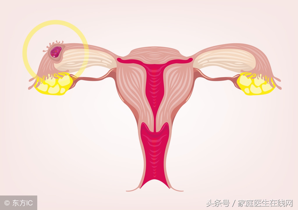 发生宫外孕怎么办？医生：符合这4个条件，药物都能治疗