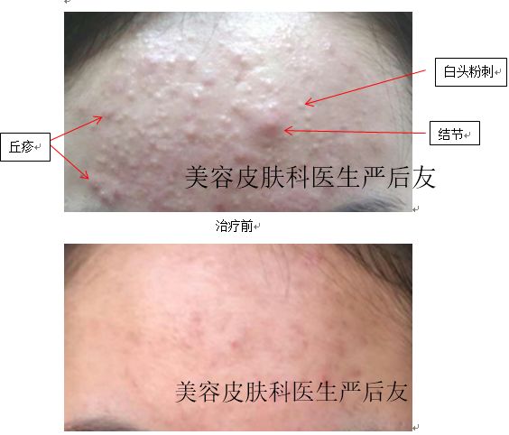 教大家认识不同类型的痘痘和治疗方法