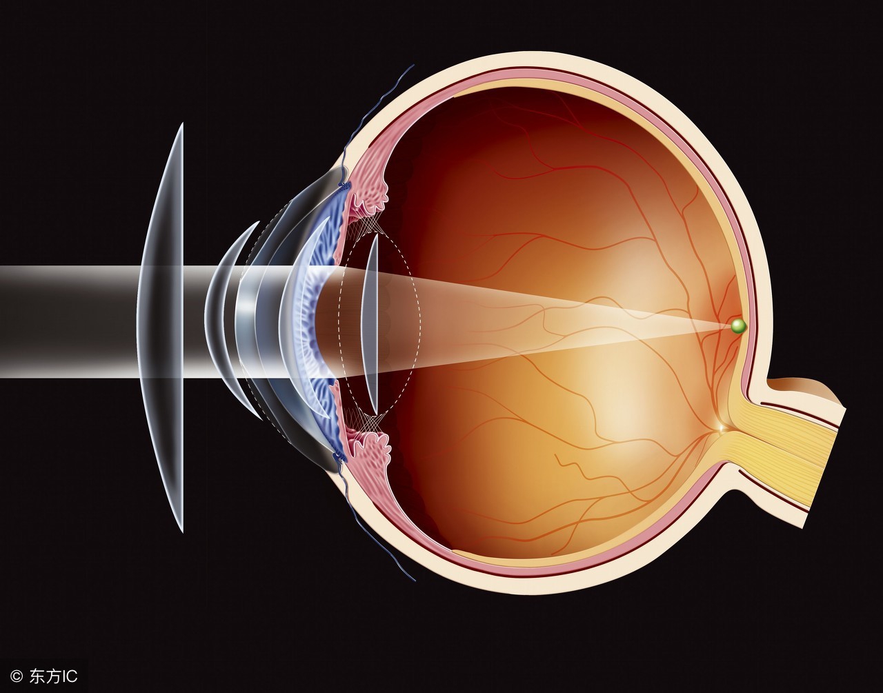 眼睛飞蚊症怎么治飞蚊症可通过物理和药理进行治疗
