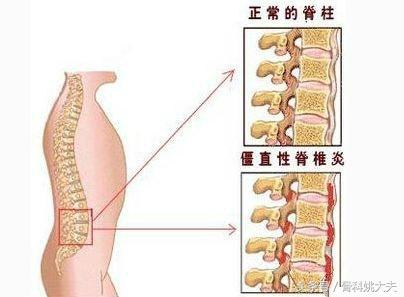 强直性脊柱炎能不能治好（强直性脊柱炎最好的治疗办法）