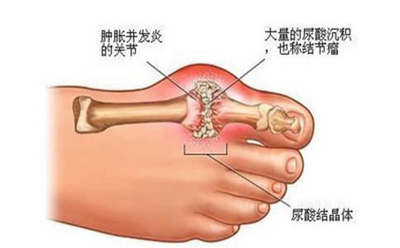 什么是痛风？痛风是什么原因引起的