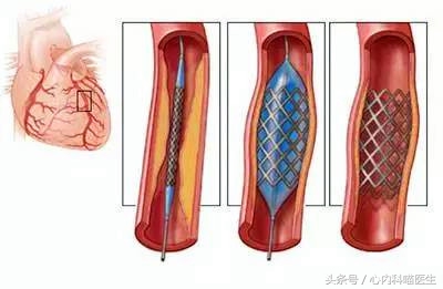 心臟病康復保養至關重要，做好醫療保健的4S店