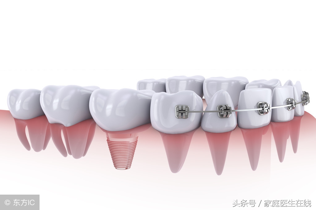 牙齿矫正靠谱吗？这三种方法，还你一口整齐牙齿