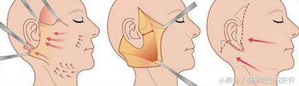面部拉皮除皱为什么会导致耳朵变形呢