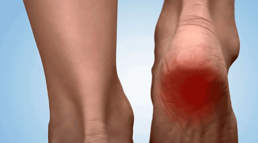 脚后跟疼怎么回事？5 个方法缓解疼痛