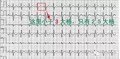 这么教你看心电图，还有什么理由看不懂？