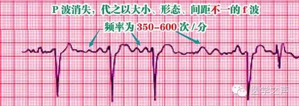 这么教你看心电图，还有什么理由看不懂？