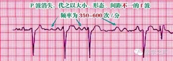 这么教你看心电图，还有什么理由看不懂？