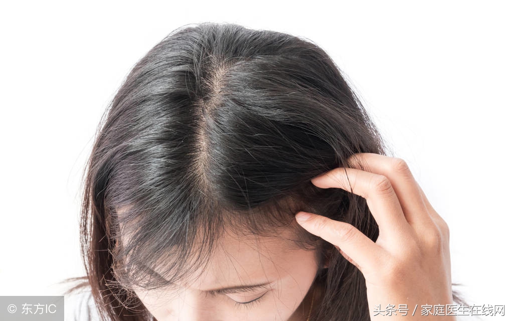 头上总有很多头皮屑？或是3个原因导致的头癣，还有传染性